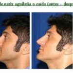 Nariz perfecta - Respingador Nasal respingador de nariz
